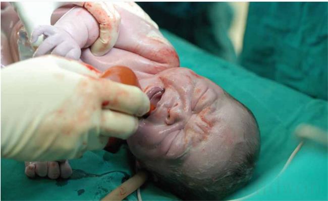 婴儿出生后颅骨骨折该如何处理