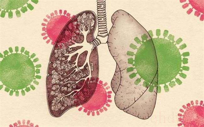 甲流会造成肺部后遗症吗