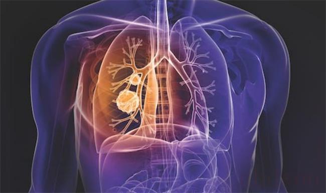 将肺癌筛查列入医保（能降低人们的医疗成本吗？）