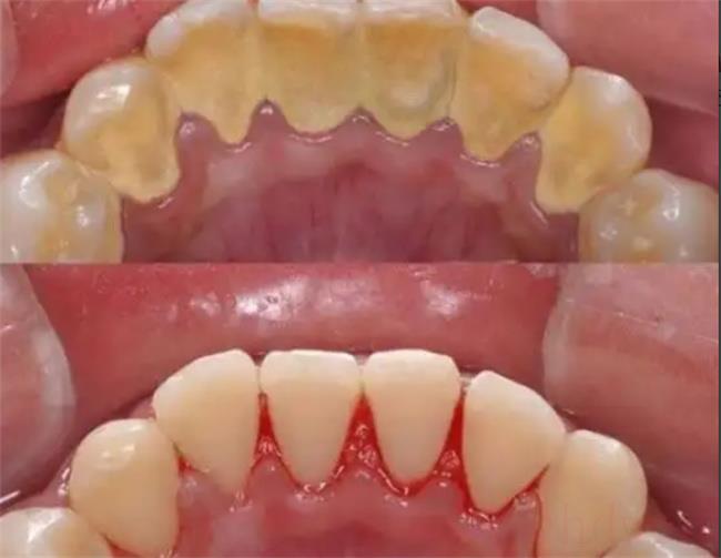 洗牙后有牙缝能恢复吗