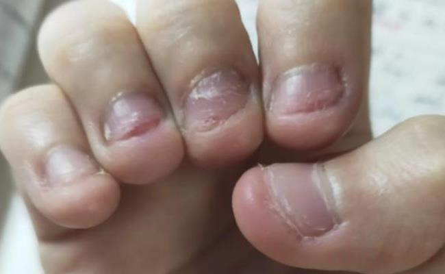 男孩啃秃10个指甲引发骨髓炎（长期啃咬指甲的后果都哪些？）