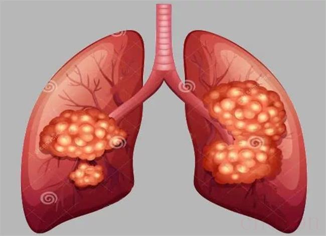 肺癌晚期治愈的可能性有多大