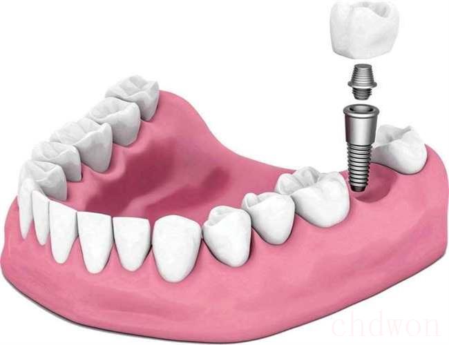 种牙和镶牙（哪种方法好）