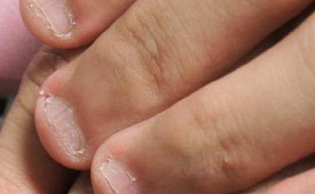 男孩啃秃10个指甲引发骨髓炎（长期啃咬指甲的后果都哪些？）