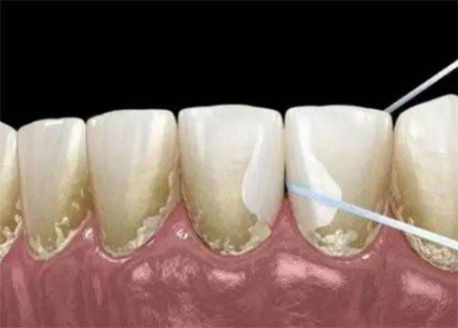 医生不建议清理牙结石有什么说法