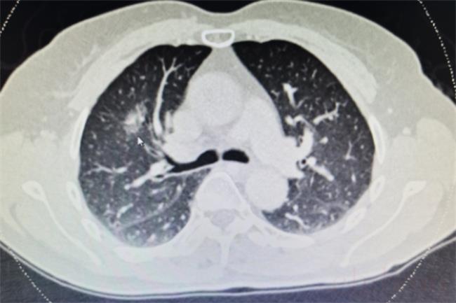哪些情况需要做肺部CT