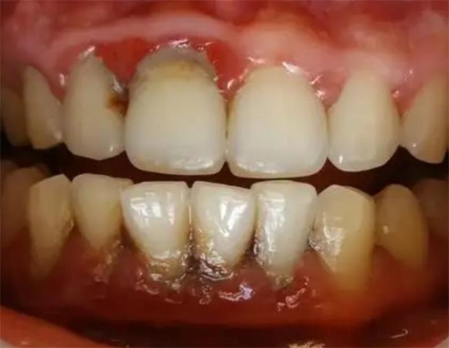 洗牙后有牙缝能恢复吗