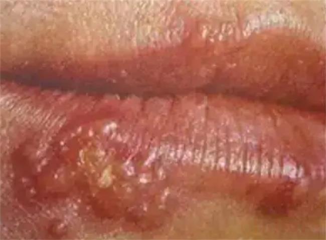 嘴上的疱疹会传染身体其他部位吗