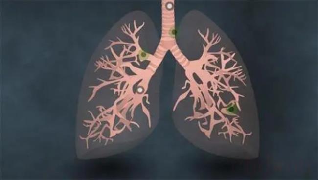 如何自测肺部是否感染