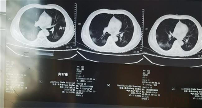 阳了怎么知道肺部是否感染