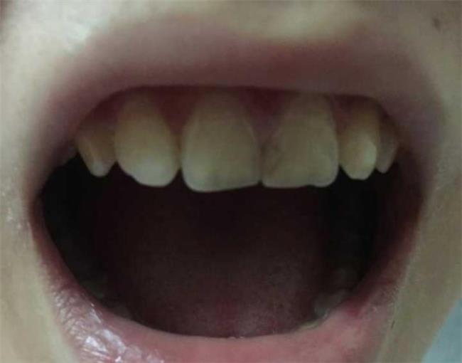 牙齿凹槽上面有黑色是蛀牙吗