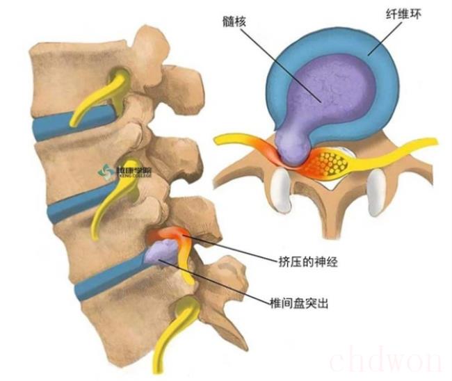 腰间盘突出症不花钱、最简单的治疗方式