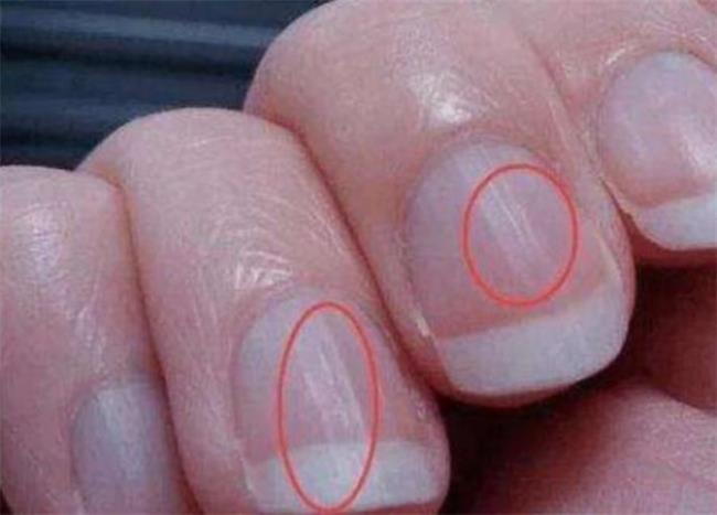 如何处理指甲表面不光滑的情况